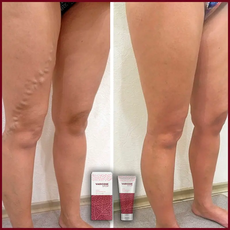 Varicose STOP відгук 1