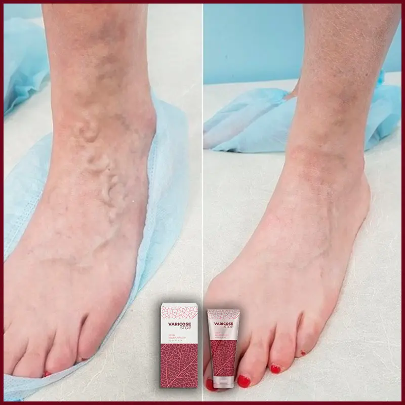 Varicose STOP відгук 2