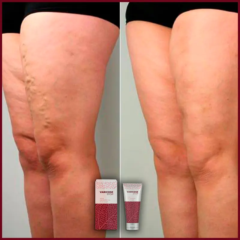 Varicose STOP відгук 3