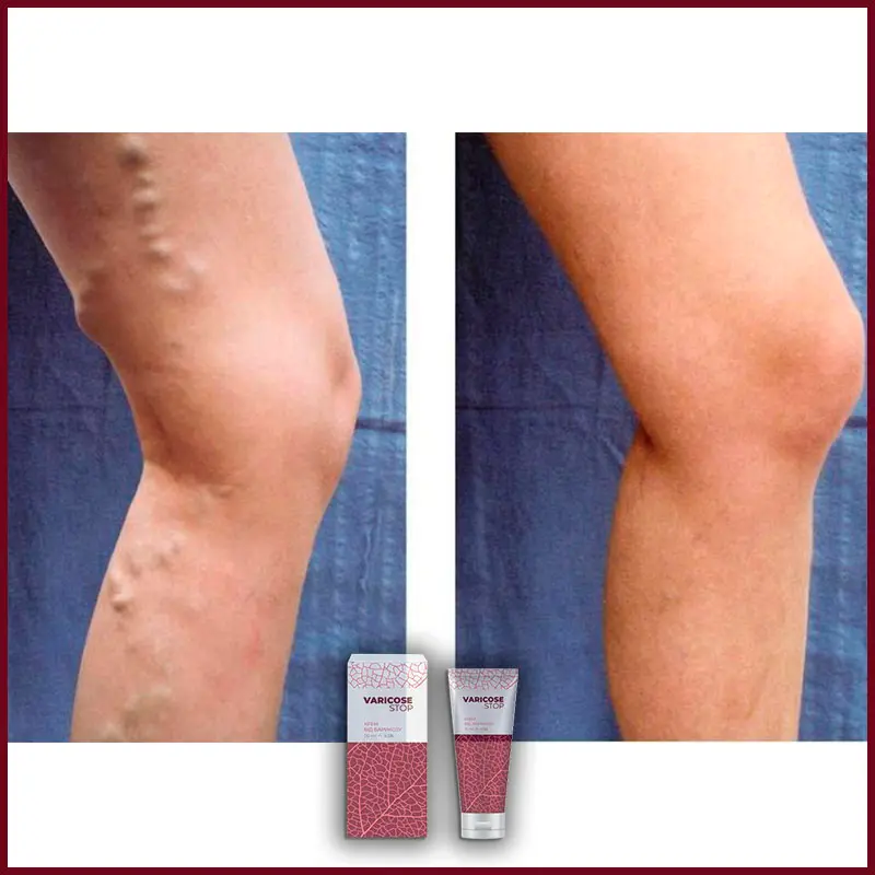 Varicose STOP відгук 5