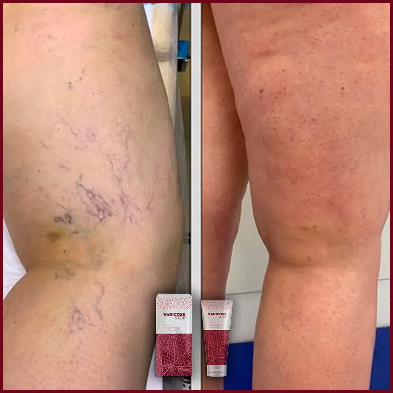 Varicose STOP відгук 7
